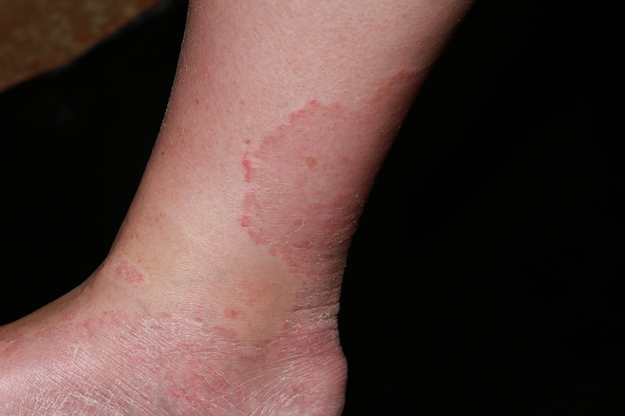 Tinea Pedis
