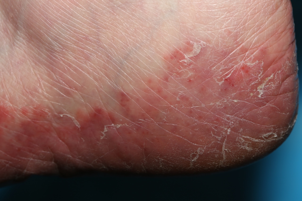 Tinea Pedis