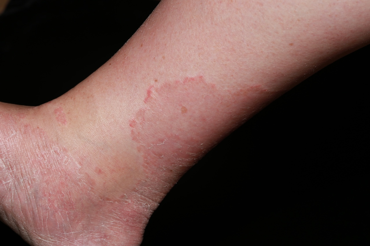 Tinea Pedis