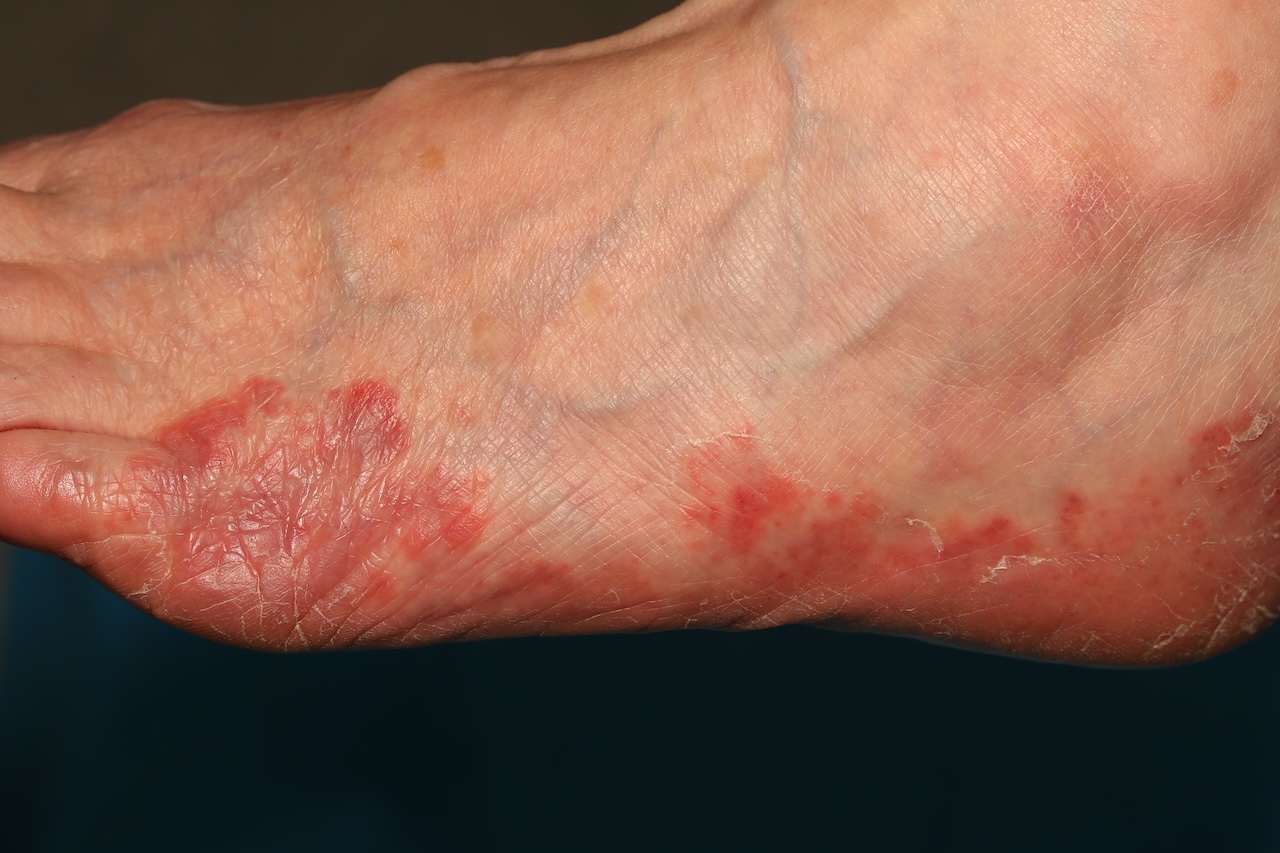 Tinea Pedis
