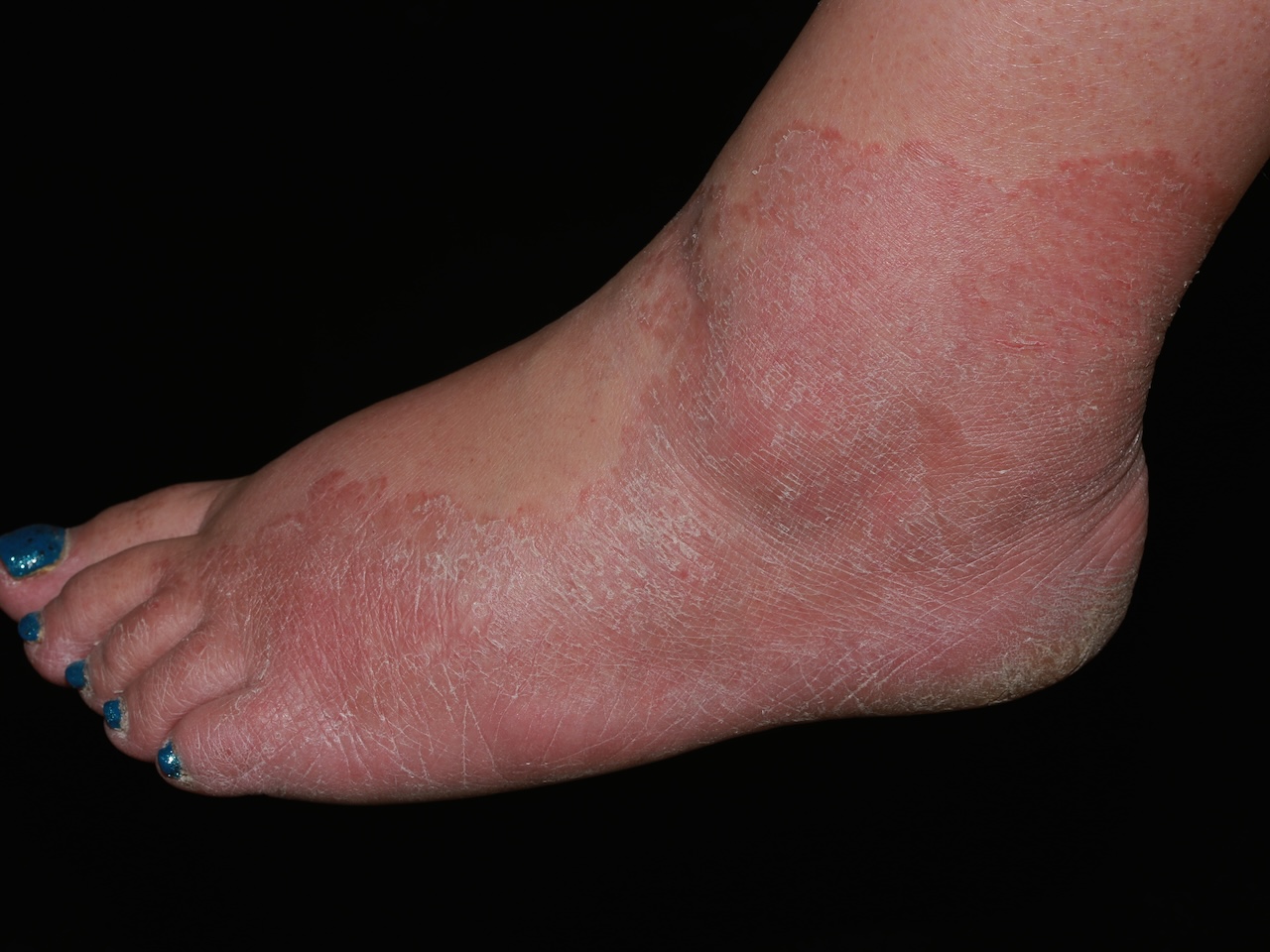 Tinea Pedis