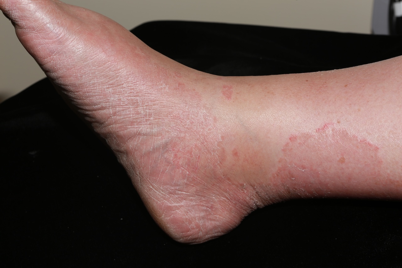 Tinea Pedis