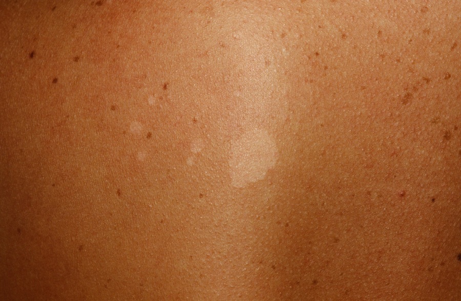 Tinea Versicolor