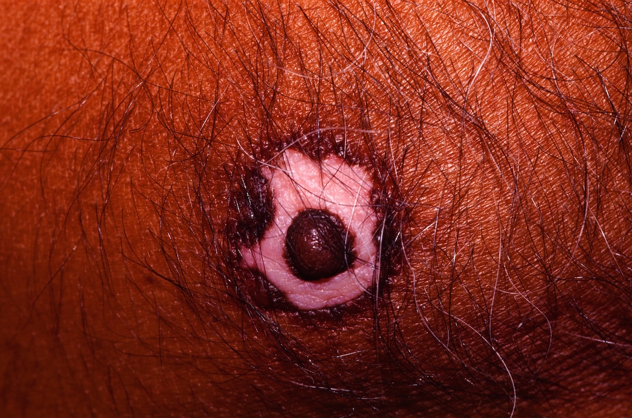 Vitiligo of the Nipple