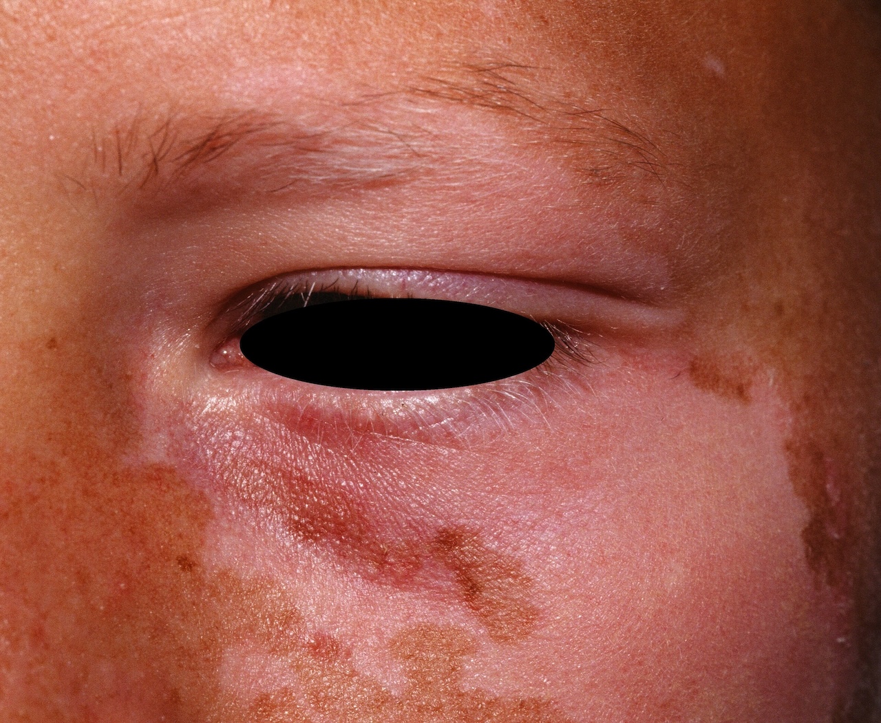 Segmental Vitiligo