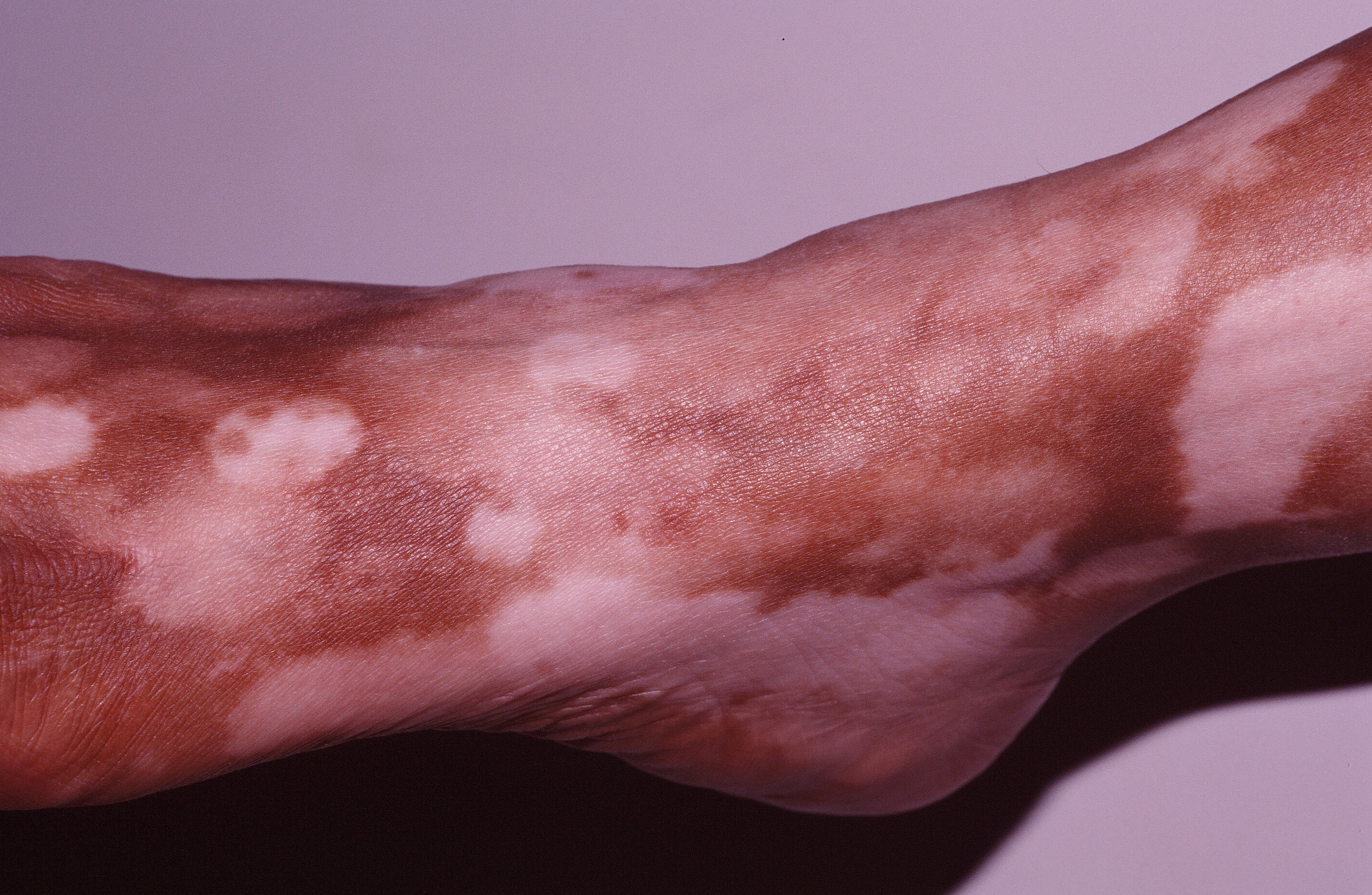 Vitiligo Trichrome